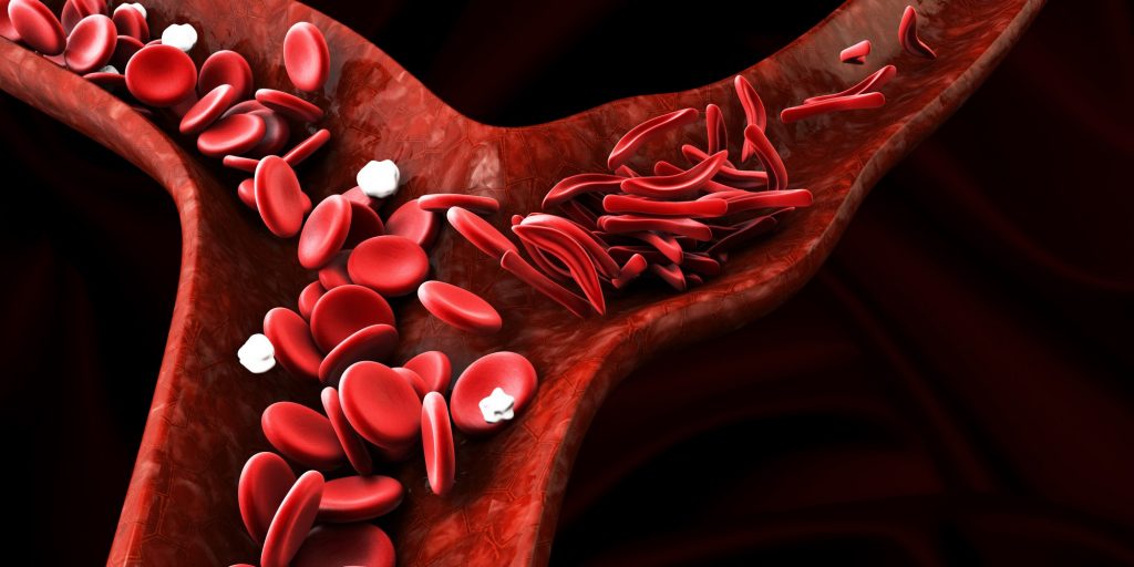 Sickle Cell Anaemia