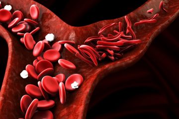 Sickle Cell Anaemia