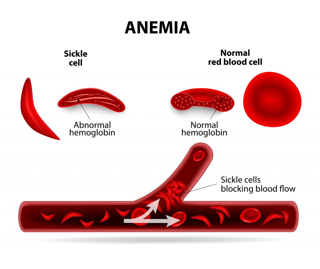 Illustration of Anaemia - International Magazine Kreol Illustration of Anaemia